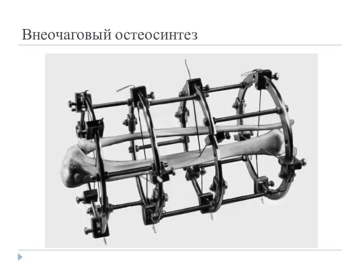 Внеочаговый остеосинтез