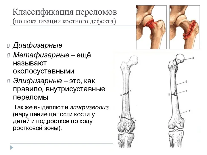 Классификация переломов (по локализации костного дефекта) Диафизарные Метафизарные – ещё