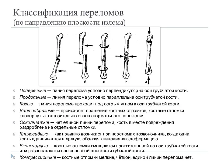 Классификация переломов (по направлению плоскости излома) Поперечные — линия перелома