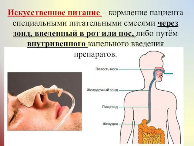 Искусственное питание – кормление пациента специальными питательными смесями через зонд,