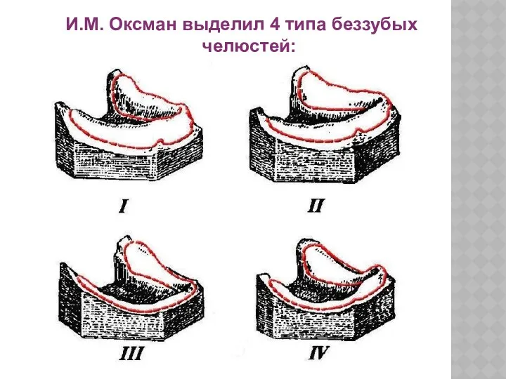 И.М. Оксман выделил 4 типа беззубых челюстей: