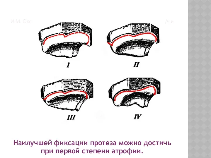 И.М. Оксман в 1967 году предложил свою классификацию для в/ч