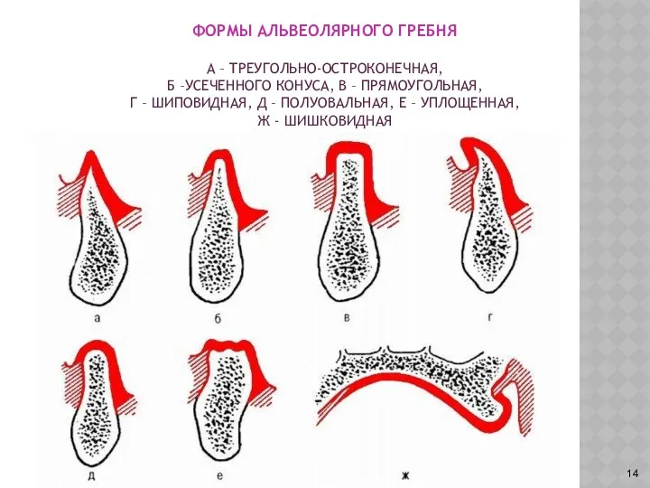 ФОРМЫ АЛЬВЕОЛЯРНОГО ГРЕБНЯ А – ТРЕУГОЛЬНО-ОСТРОКОНЕЧНАЯ, Б –УСЕЧЕННОГО КОНУСА, В