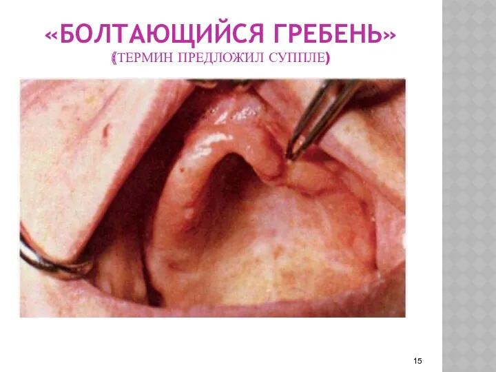 «БОЛТАЮЩИЙСЯ ГРЕБЕНЬ» (ТЕРМИН ПРЕДЛОЖИЛ СУППЛЕ)