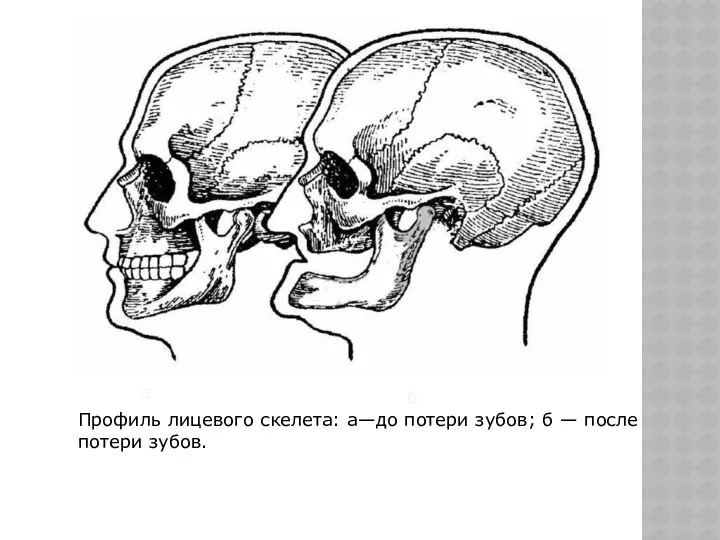 Профиль лицевого скелета: а—до потери зубов; б — после потери зубов. а б