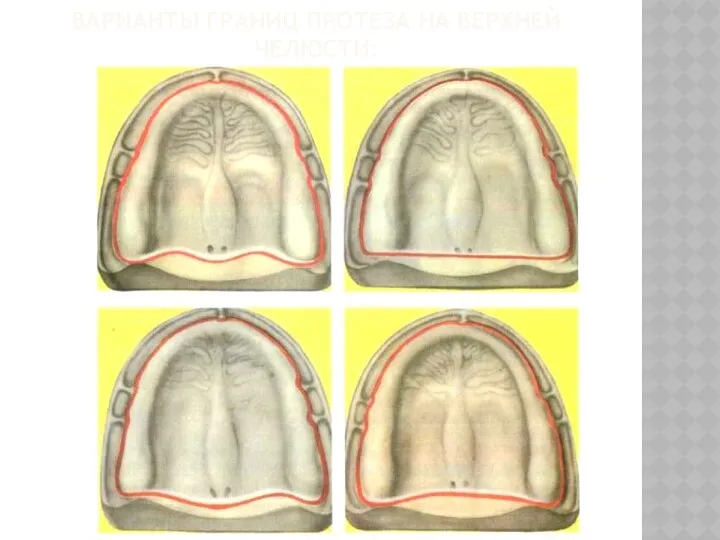 ВАРИАНТЫ ГРАНИЦ ПРОТЕЗА НА ВЕРХНЕЙ ЧЕЛЮСТИ: