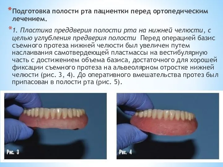 Подготовка полости рта пациентки перед ортопедическим лечением. 1. Пластика преддверия полости рта на