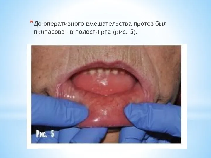 До оперативного вмешательства протез был припасован в полости рта (рис. 5).