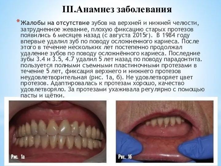 Жалобы на отсутствие зубов на верхней и нижней челюсти, затрудненное жевание, плохую фиксацию