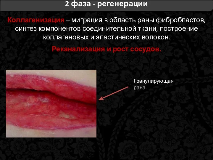 2 фаза - регенерации Коллагенизация – миграция в область раны