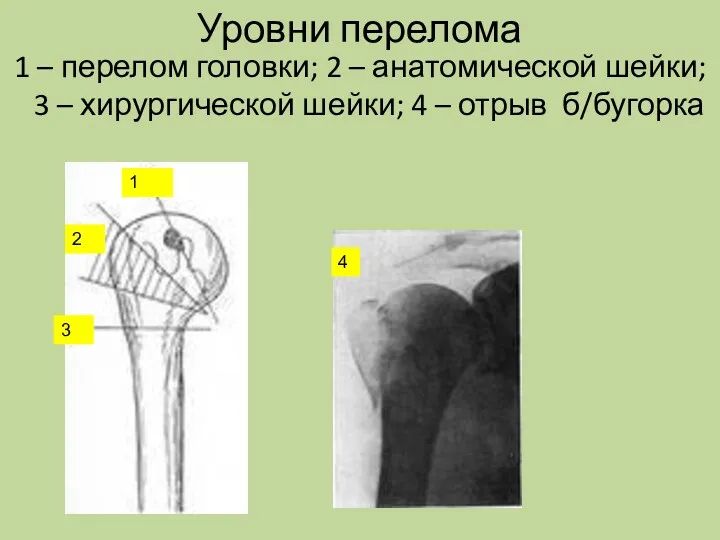 Уровни перелома 1 – перелом головки; 2 – анатомической шейки;