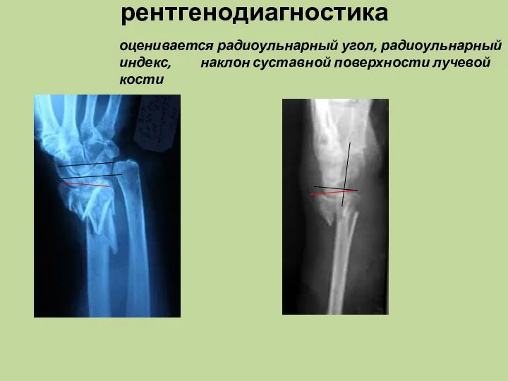рентгенодиагностика оценивается радиоульнарный угол, радиоульнарный индекс, наклон суставной поверхности лучевой кости