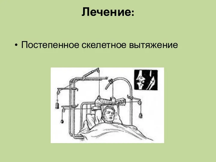 Лечение: Постепенное скелетное вытяжение