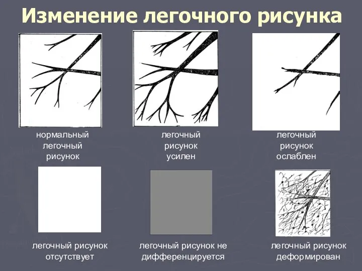 Изменение легочного рисунка нормальный легочный рисунок легочный рисунок усилен легочный