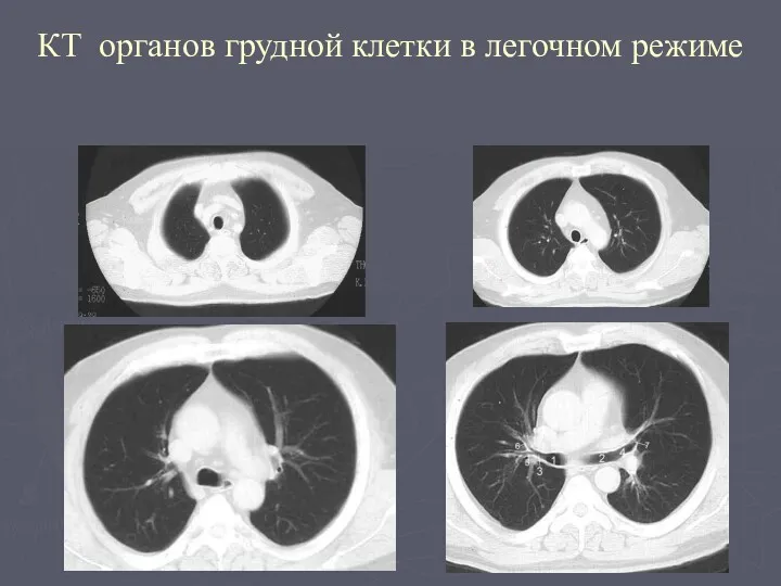 КТ органов грудной клетки в легочном режиме