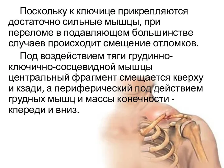 Поскольку к ключице прикрепляются достаточно сильные мышцы, при переломе в