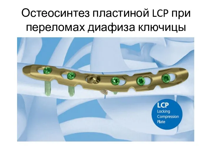 Остеосинтез пластиной LCP при переломах диафиза ключицы