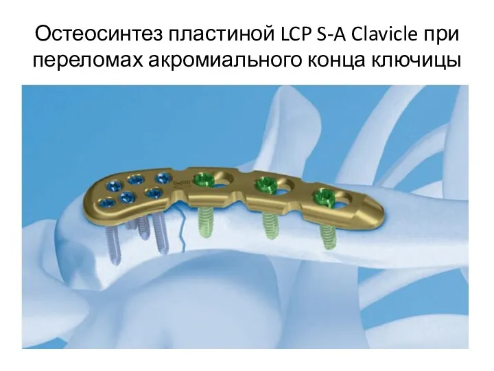 Остеосинтез пластиной LCP S-A Clavicle при переломах акромиального конца ключицы