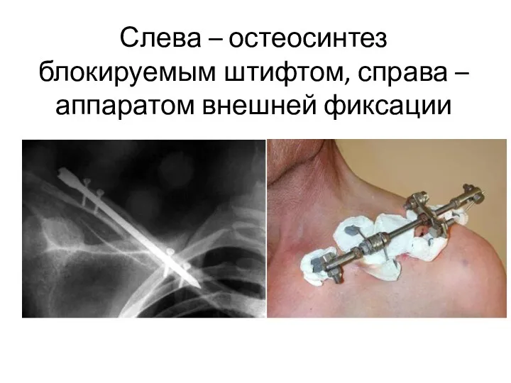 Слева – остеосинтез блокируемым штифтом, справа – аппаратом внешней фиксации