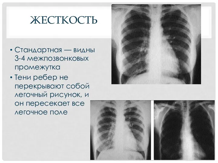 ЖЕСТКОСТЬ Стандартная — видны 3-4 межпозвонковых промежутка Тени ребер не