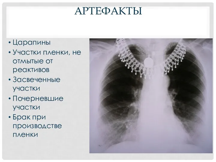 АРТЕФАКТЫ Царапины Участки пленки, не отмытые от реактивов Засвеченные участки Почерневшие участки Брак при производстве пленки