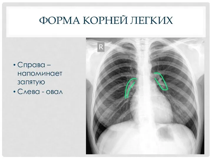 ФОРМА КОРНЕЙ ЛЕГКИХ Справа – напоминает запятую Слева - овал