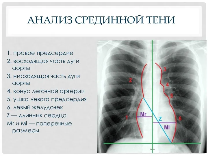 АНАЛИЗ СРЕДИННОЙ ТЕНИ 1. правое предсердие 2. восходящая часть дуги