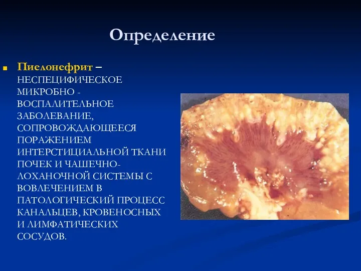 Определение Пиелонефрит – НЕСПЕЦИФИЧЕСКОЕ МИКРОБНО - ВОСПАЛИТЕЛЬНОЕ ЗАБОЛЕВАНИЕ, СОПРОВОЖДАЮЩЕЕСЯ ПОРАЖЕНИЕМ