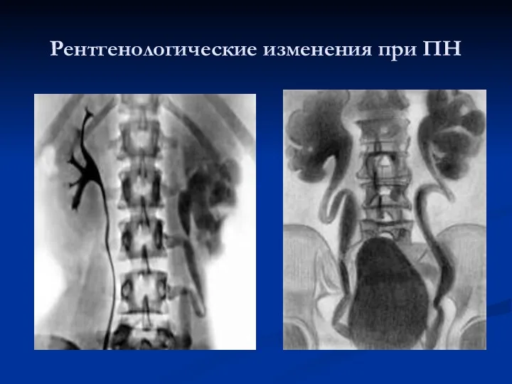 Рентгенологические изменения при ПН