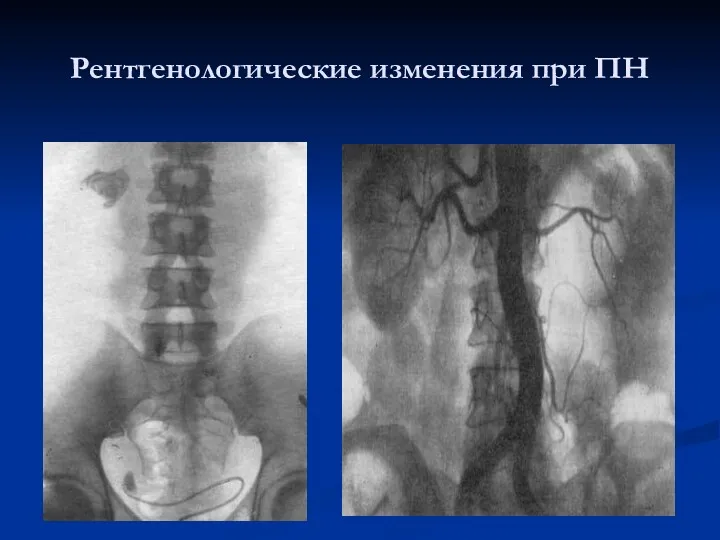 Рентгенологические изменения при ПН