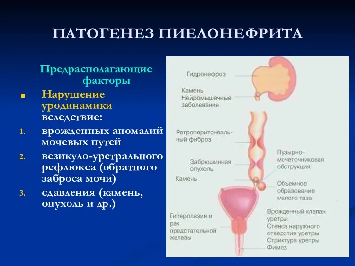 ПАТОГЕНЕЗ ПИЕЛОНЕФРИТА Предрасполагающие факторы Нарушение уродинамики вследствие: врожденных аномалий мочевых