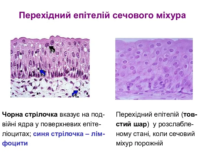 Перехідний епітелій сечового міхура Чорна стрілочка вказує на под- війні