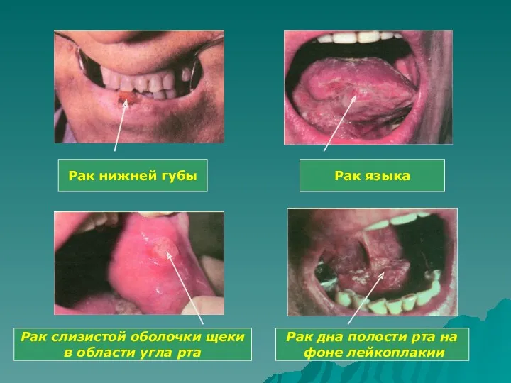 Рак нижней губы Рак языка Рак слизистой оболочки щеки в