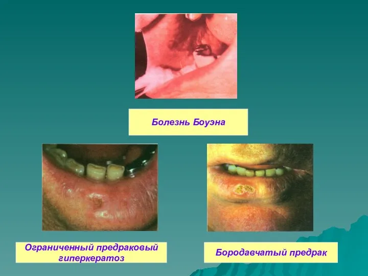 Болезнь Боуэна Ограниченный предраковый гиперкератоз Бородавчатый предрак