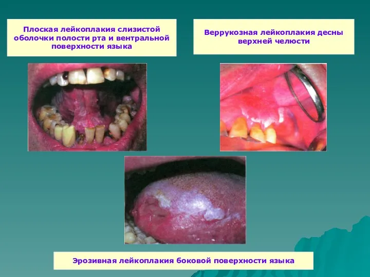 Плоская лейкоплакия слизистой оболочки полости рта и вентральной поверхности языка