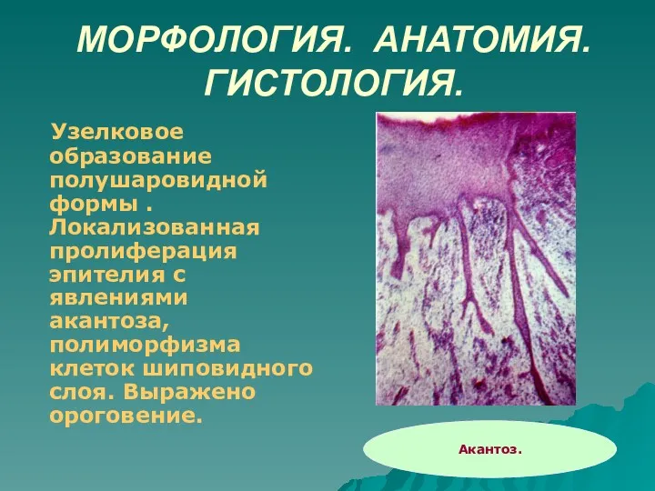 МОРФОЛОГИЯ. АНАТОМИЯ. ГИСТОЛОГИЯ. Узелковое образование полушаровидной формы . Локализованная пролиферация