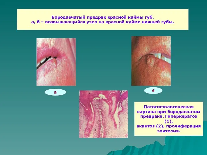 Бородавчатый предрак красной каймы губ. а, б – возвышающийся узел