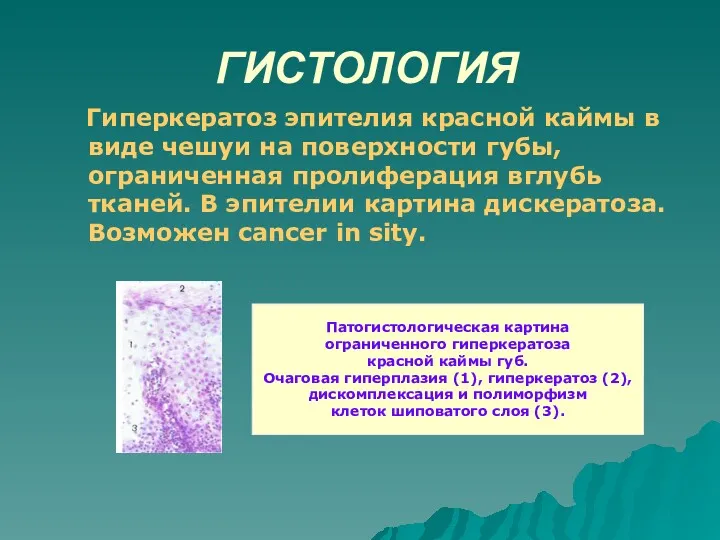 ГИСТОЛОГИЯ Гиперкератоз эпителия красной каймы в виде чешуи на поверхности