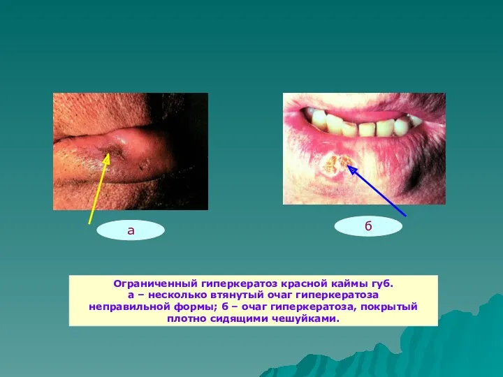 Ограниченный гиперкератоз красной каймы губ. а – несколько втянутый очаг