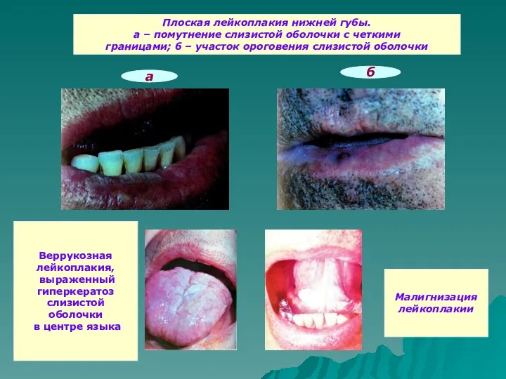 Плоская лейкоплакия нижней губы. а – помутнение слизистой оболочки с