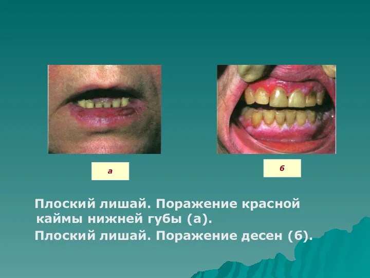 Плоский лишай. Поражение красной каймы нижней губы (а). Плоский лишай. Поражение десен (б). а б