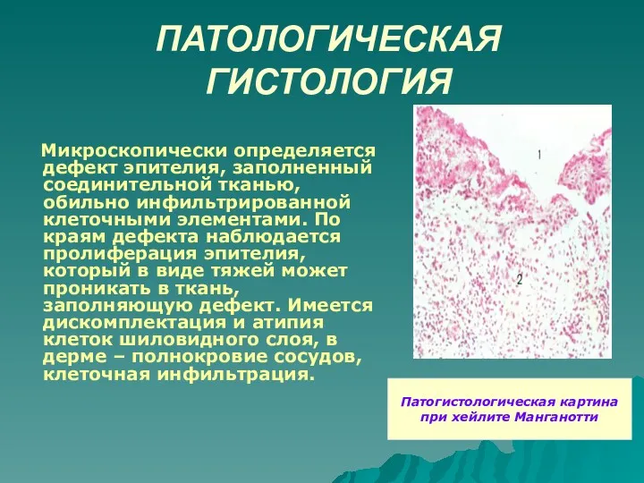 ПАТОЛОГИЧЕСКАЯ ГИСТОЛОГИЯ Микроскопически определяется дефект эпителия, заполненный соединительной тканью, обильно