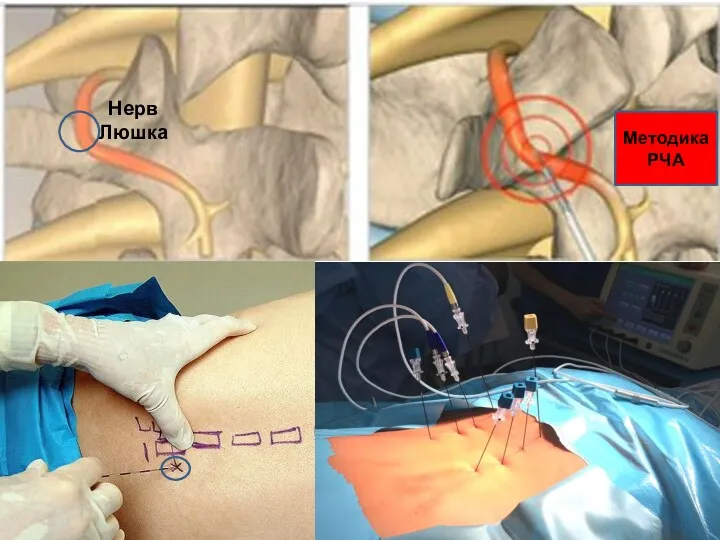 Нерв Люшка Методика РЧА