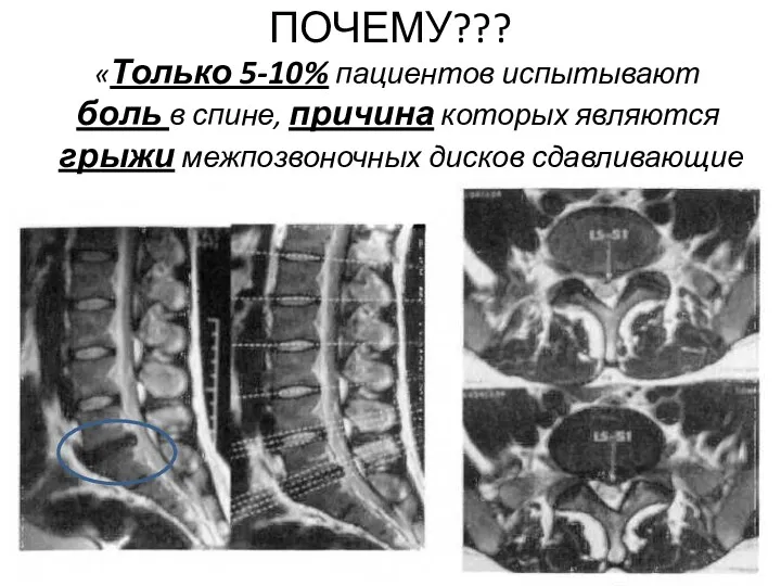 ПОЧЕМУ??? «Только 5-10% пациентов испытывают боль в спине, причина которых являются грыжи межпозвоночных дисков сдавливающие корешки»