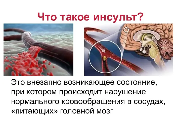 Что такое инсульт? Это внезапно возникающее состояние, при котором происходит