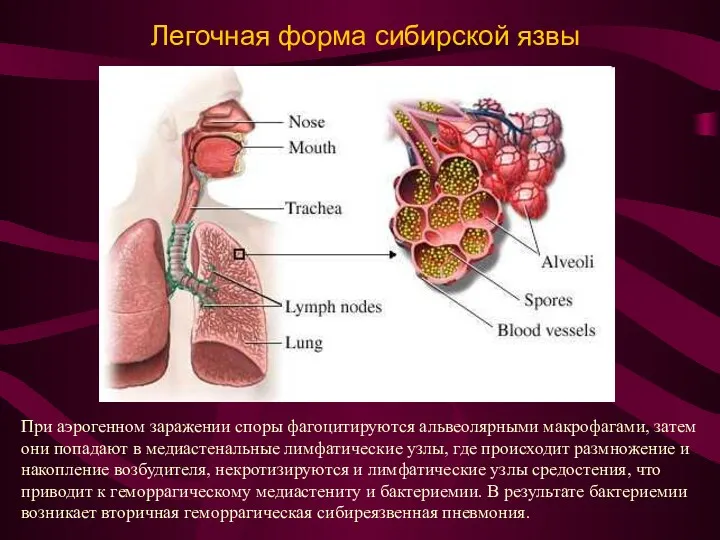 Легочная форма сибирской язвы При аэрогенном заражении споры фагоцитируются альвеолярными