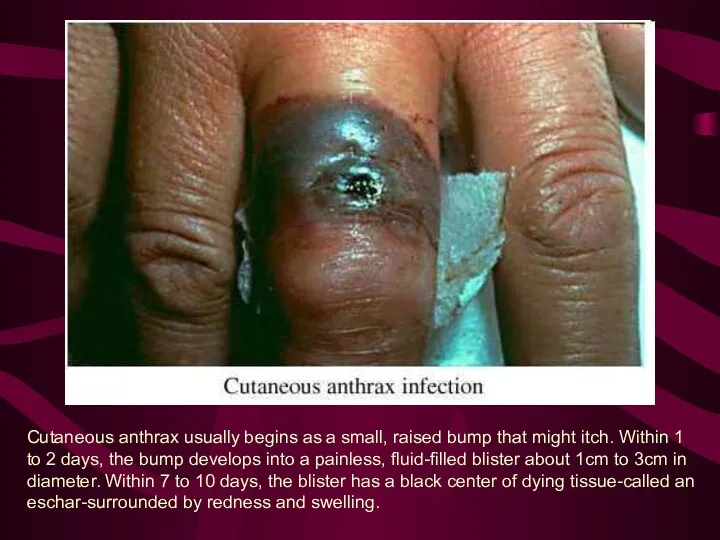 Cutaneous anthrax usually begins as a small, raised bump that