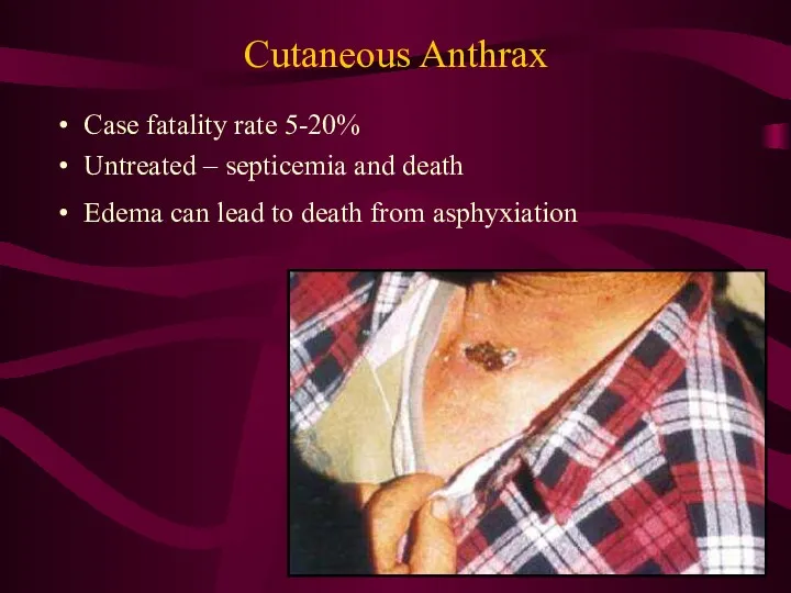 Cutaneous Anthrax Case fatality rate 5-20% Untreated – septicemia and