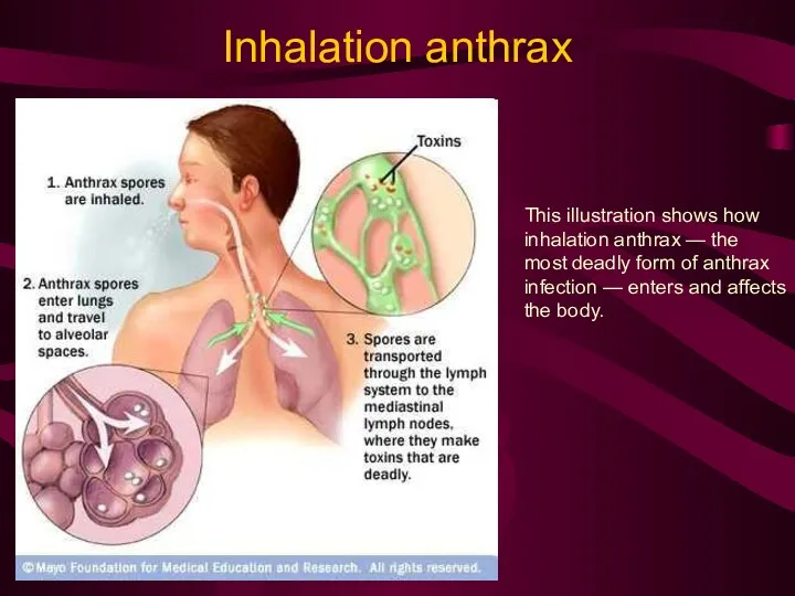 Inhalation anthrax This illustration shows how inhalation anthrax — the