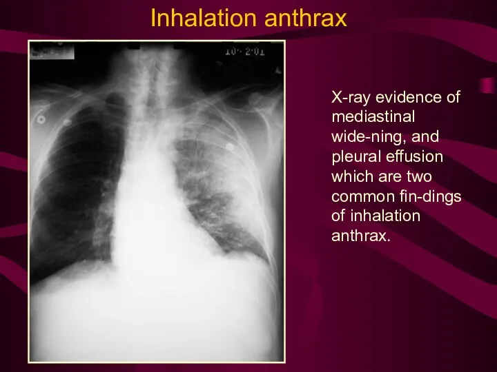 X-ray evidence of mediastinal wide-ning, and pleural effusion which are